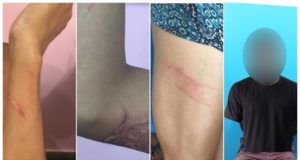 Com queimaduras pelo corpo, ex-companheira denuncia agricultor por violência domestica no AM