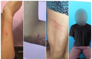 Com queimaduras pelo corpo, ex-companheira denuncia agricultor por violência domestica no AM