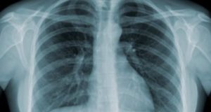 Brasil assume conselho de entidade que combate a tuberculose no mundo