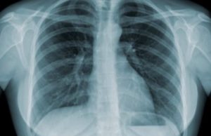 Brasil assume conselho de entidade que combate a tuberculose no mundo