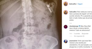 Chef de cozinha engole fone de ouvido: ”Estava no bolso com vitaminas”