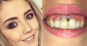 Mulher fica com queimadura na gengiva após clareamento dos dentes