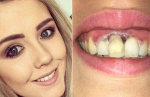 Mulher fica com queimadura na gengiva após clareamento dos dentes