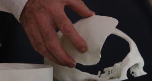 Brasileiros desenvolvem tecnologia de reconstrução craniana