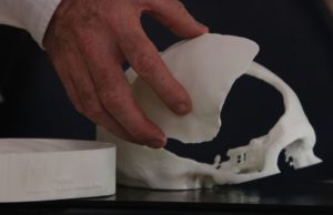 Brasileiros desenvolvem tecnologia de reconstrução craniana