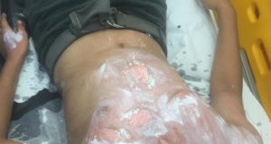 Criança é criminosamente queimada com água fervente em ManausCrime bárbaro e covarde no Manôa