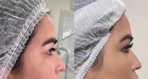 Fabíola Gadelha faz preenchimento de mandíbulaVaidosa