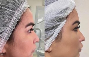 Fabíola Gadelha faz preenchimento de mandíbulaVaidosa