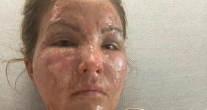 Mulher tem corpo parcialmente queimado após álcool gel pegar fogoMoradora do Texas precisou passar por cirurgia por causa das queimaduras de segundo e terceiro grau. Casa onde ela e as filhas moravam ficou toda destruída.