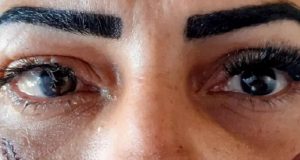 Mulher fica com visão comprometida após colocar cílios postiços em clínica de estéticaDe acordo com a vítima, a responsável pelo procedimento deixou cair a cola dentro dos seus olhos