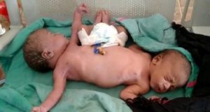 Gêmeas siamesas nascem com duas pernas e quatro braçosO pai espera que seja possível realizar uma cirurgia de separação no futuro