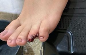 Jovem perde parte do dedo do pé após ataque de piranhas em praiaO fato aconteceu no município de Itaituba, no Pará