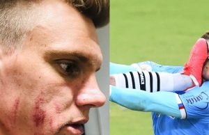 Goleiro do Bahia exibe as marcas das chuteiras do vascaíno Leandro Castán