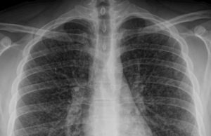 Paciente transplantada morre de Covid após receber pulmões infectadosTriste engano