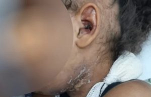 Pai e madrasta são suspeitos de espancar criança que perdeu mãe para CovidAlém de hematomas, ela teve um dos braços quebrados