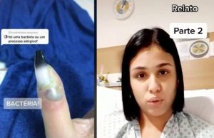 Jovem perde a ponta do dedo após colocar unha de acrigel; veja o vídeo