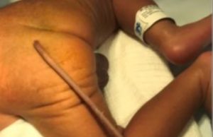 Raridade: bebê nasce com cauda de 12 centímetros e passa por cirurgia de remoção no BrasilCiência