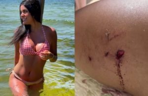 Influenciadora digital é internada após sofrer ataque de pitbull não vacinado contra a raivaRisco de morte