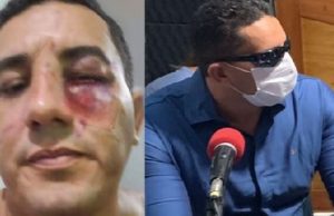 Um dia após lutar MMA com ex-vereador, prefeito de Borba aparece com o rosto machucadoQual a necessidade?