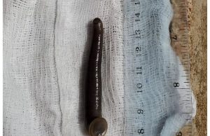 Sanguessuga é encontrada em garganta de criança de três anos com tosse intensaO sanguessuga de 6 centímetros foi retirado por meio de uma endoscopia, e estava presa na parede do esôfago