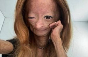 Morre Adalia Rose, youtuber que sofria de doença semelhante à de Benjamin Button