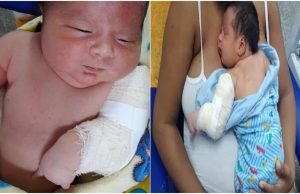 Bebê de Itacoatiara tem braço quebrado no parto é transferido para Manaus e mãe pede ajuda na internetA família acusa o medido de irresponsabilidade na hora do parto