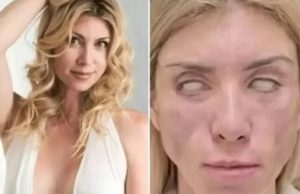 Após cirurgia plástica, miss Russa não consegue fechar os olhos nem sorrir