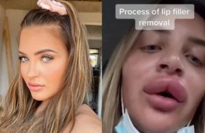 Tiktoker mostra processo traumático de remoção do preenchimento labial: “vergonha”