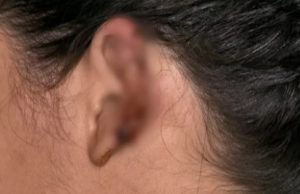 COVARDE – Homem arranca na mordida parte da orelha da ex-mulher durante brigaAlém da mordida na orelha, a dona de casa ficou machucada por todo o corpo, porque o homem também a atacou com chutes e socos