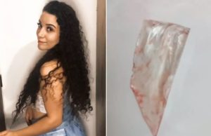 Jovem fica com vidro alojado nas costas quase um mês e hospital não percebe objetoSegundo a mãe, na UPA, o médico não solicitou que a jovem fizesse exame de raio-x e também não foi feita nenhuma receita médica com remédios