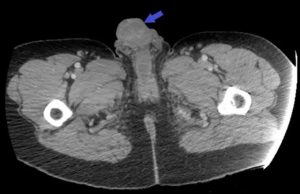 IMAGENS FORTES: homem injeta cocaína no pênis e membro apodreceO paciente assumiu que já tinha feito o procedimento antes e que não houve problemas