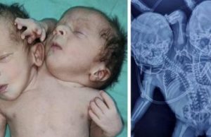 CASO RARO – Bebê surpreende ao nascer com duas cabeças, três braços e dois coraçõesO nascimento das crianças parece ser um caso raro de gêmeos siameses, conhecido como parapagus dicefálico - onde dois bebês são unidos por um torso