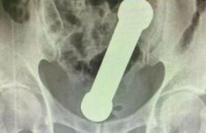 Médicos encontram peso de 2 quilos dentro de paciente em ManausO haltere estava entre o reto e o intestino grosso do paciente, que, depois do exame, admitiu ter introduzido o peso de academia no corpo para obter satisfação sexual