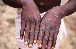 Novo caso suspeito de varíola dos macacos é registrado na Argentina