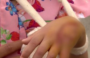 Menina de 4 anos tem pele da mão arrancada por raio-x de presídio, em Manaus