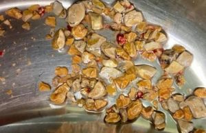 EITA! Médicos retiram 206 pedras dos rins de paciente