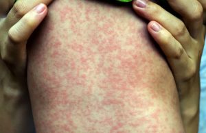 Bebê de 1 ano é confirmado como 1º caso de sarampo no AmazonasCriança de 1 ano, sem vacinação da tríplice viral, em Manacapuru