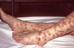 Varíola dos Macacos avança no Brasil e contamina 76 pessoasPreocupação