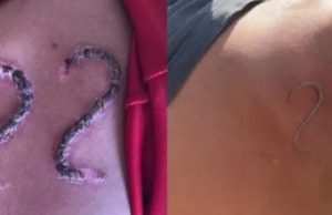 Adolescente usa ferro em brasa para carimbar nº 22 de Bolsonaro na própria peleSerá que doeu?