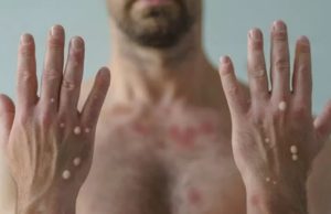 Dois casos de Varíola dos Macacos são monitorados em Manaus