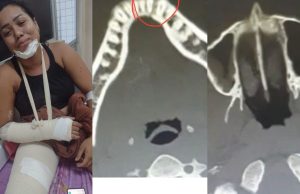 Família pede ajuda para cirurgia de jovem que sofreu acidente de trânsito gravíssimo em Manaus