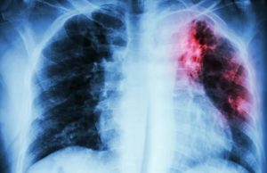 ALERTA – Manaus registra 1.508 novos casos de tuberculoseA transmissão da tuberculose ocorre quando, ao falar, espirrar e, principalmente, ao tossir, as pessoas com tuberculose ativa lançam no ar