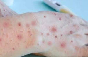 Amazonas tem 9 casos suspeitos de varíola dos macacos