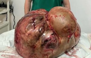 Morre mulher que teve tumor de 46 kg retirado em cirurgia de emergência