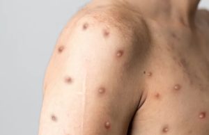 Amazonas notifica 556 casos de varíola dos macacos