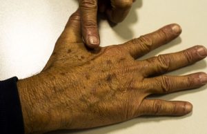 Brasil terá 704 mil novos casos de câncer por ano até 2025, diz IncaMama e próstata são as doenças de maior incidência