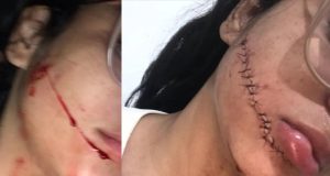 Jovem tem rosto cortado dentro de ônibus: ‘Senti um impacto e acordei’As imagens da câmera que fica dentro do veículo deverão ser analisadas pela polícia