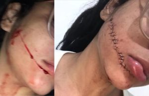 Jovem tem rosto cortado dentro de ônibus: ‘Senti um impacto e acordei’As imagens da câmera que fica dentro do veículo deverão ser analisadas pela polícia