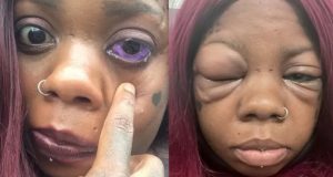 Mulher tatua globos oculares e pode perder a visão