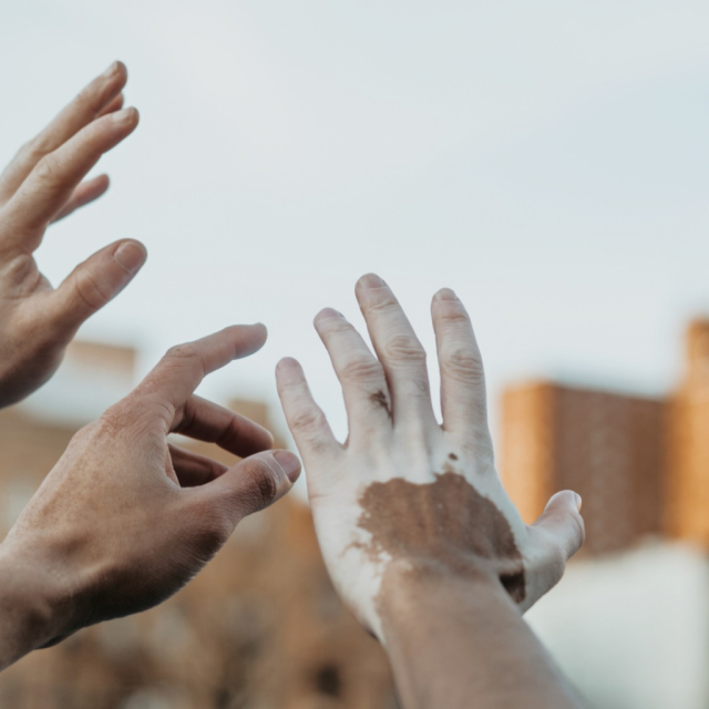 Vitiligo alerta para alto número de casos no Estado Vitiligo: alerta para alto número de casos no Estado